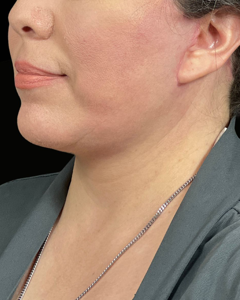 Case--7936 | After Facelift/Neck Lift