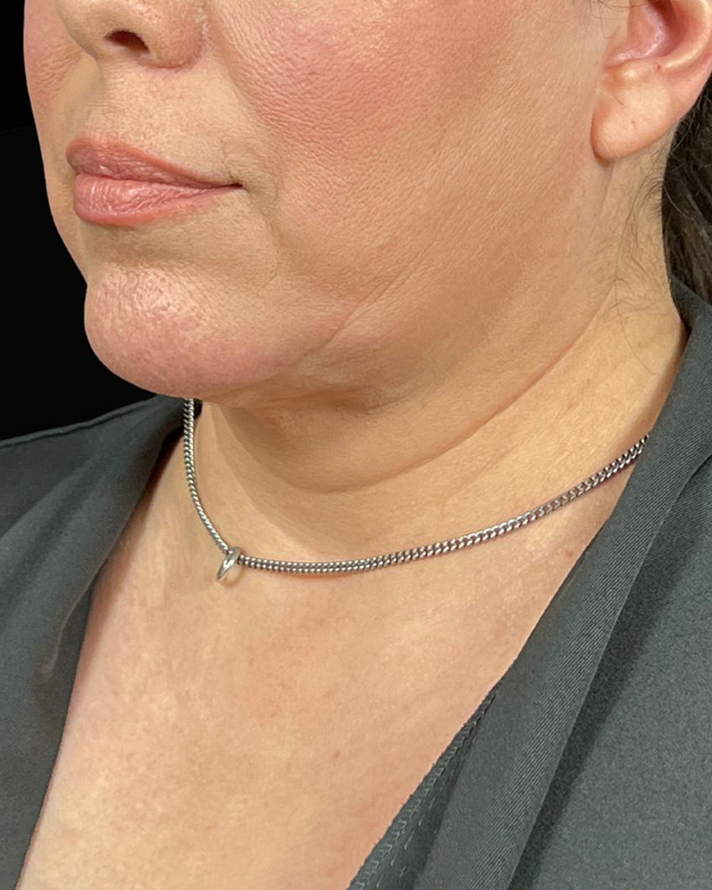 Case--7936 | Before Facelift/Neck Lift