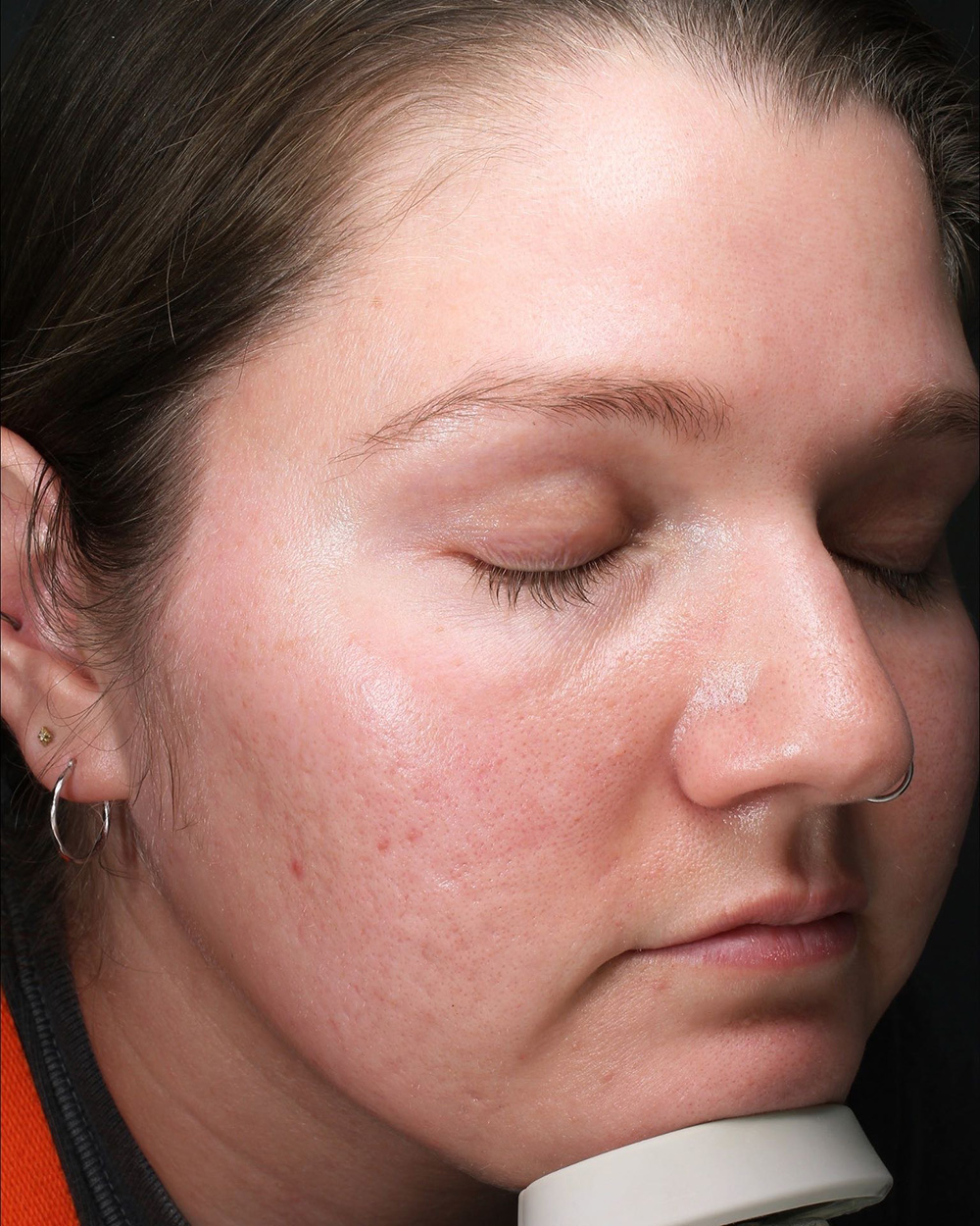 Case--2596 | After Lesion Removal