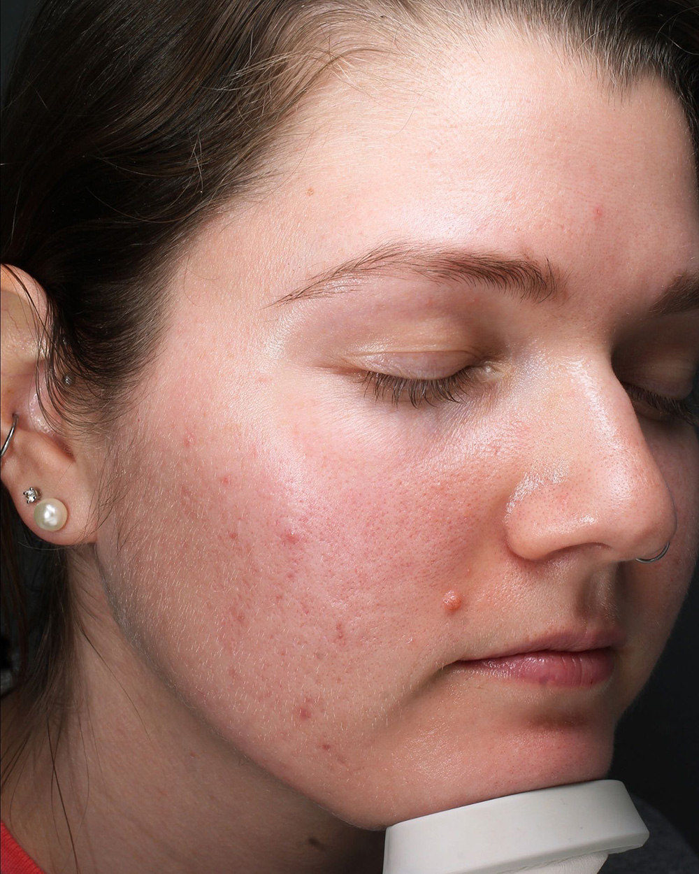 Case--2596 | Before Lesion Removal