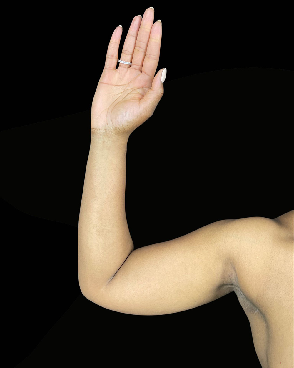 Case--8555 | Before Liposuction