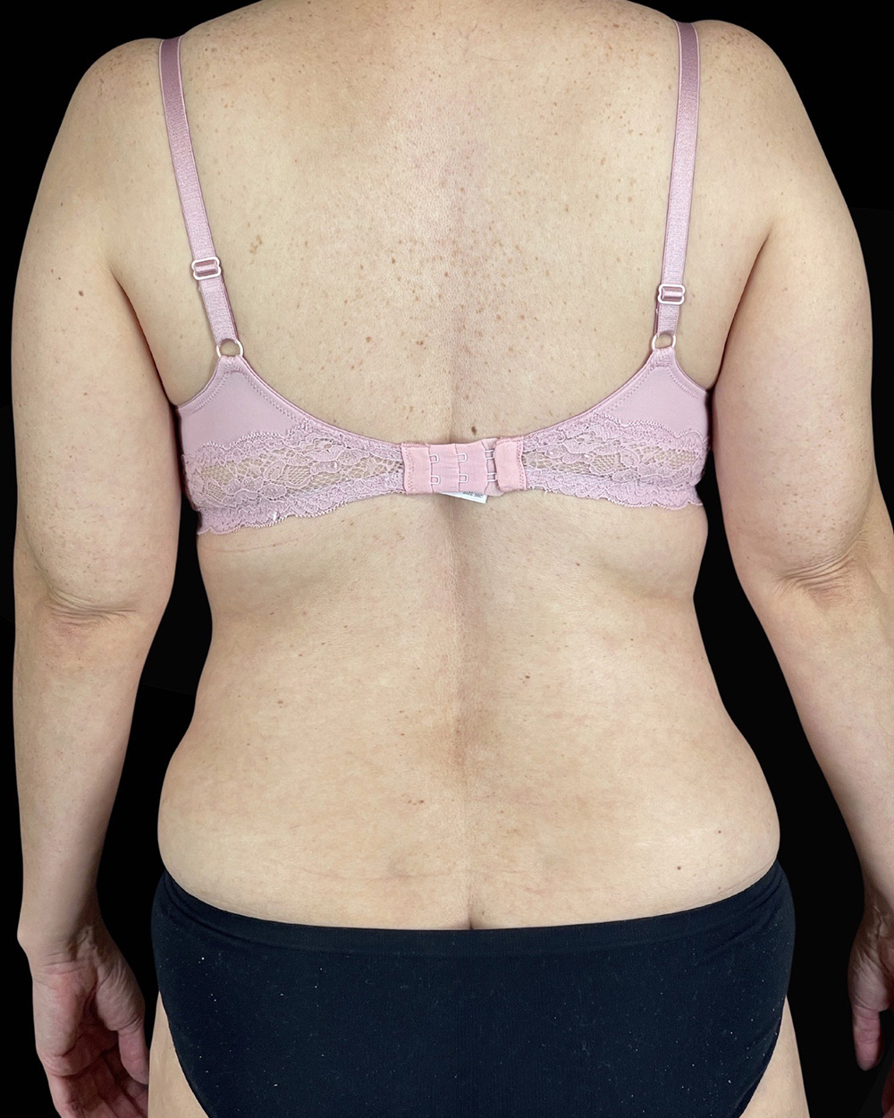 Case--1961 | After Liposuction 2