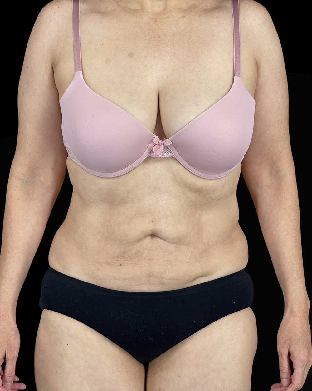 Case--1961 | After Liposuction