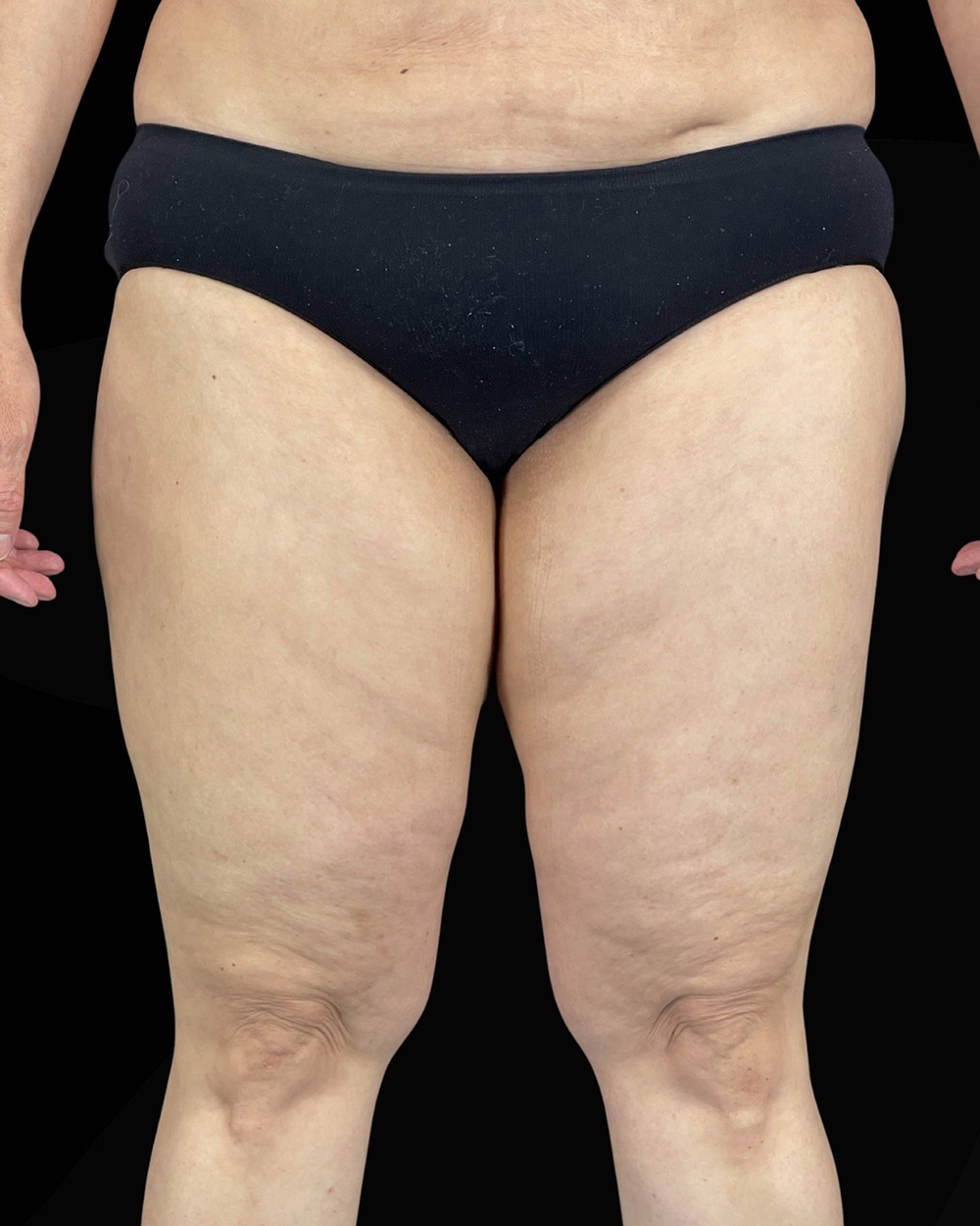 Case--1961 | After Liposuction 3