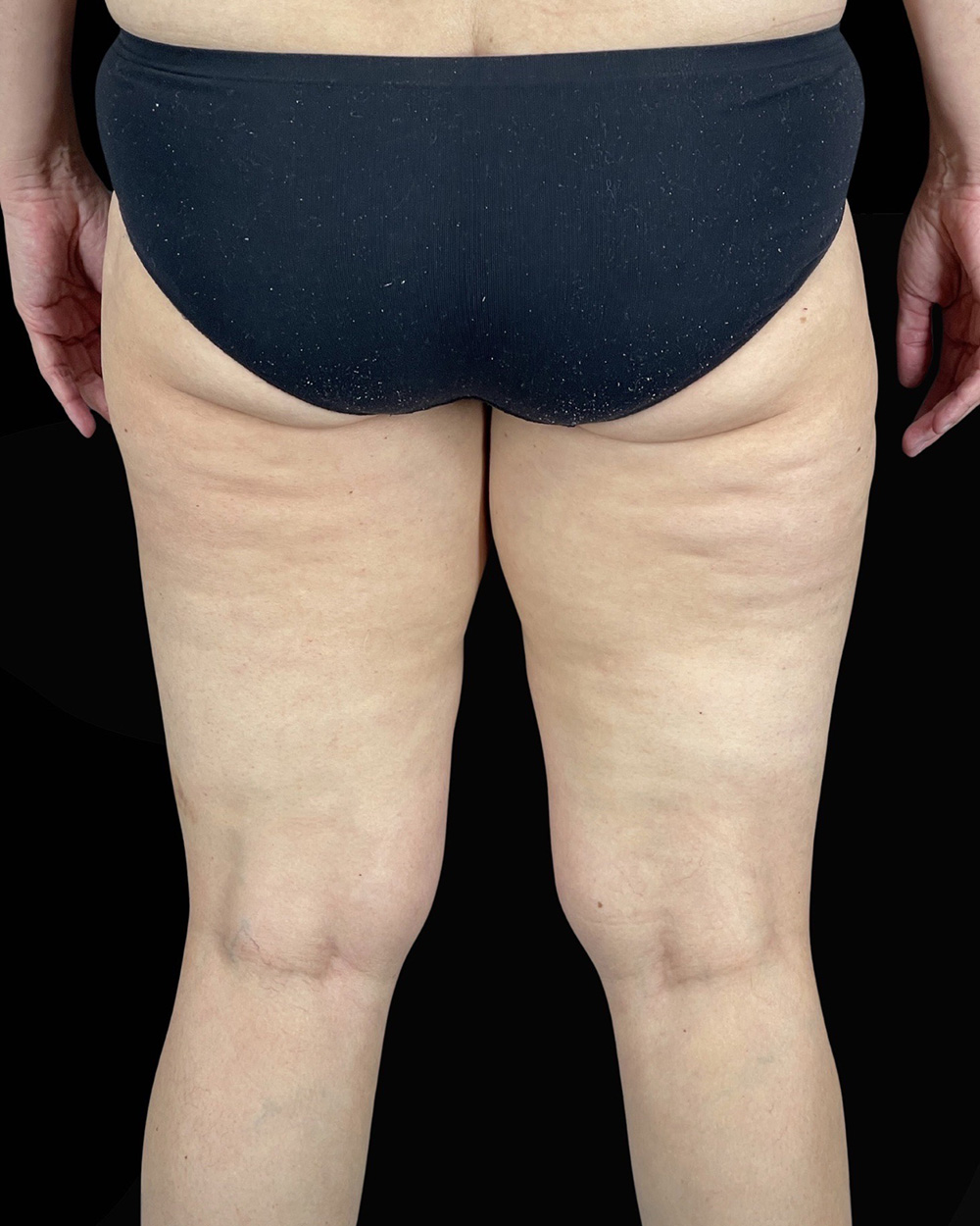 Case--1961 | After Liposuction 4