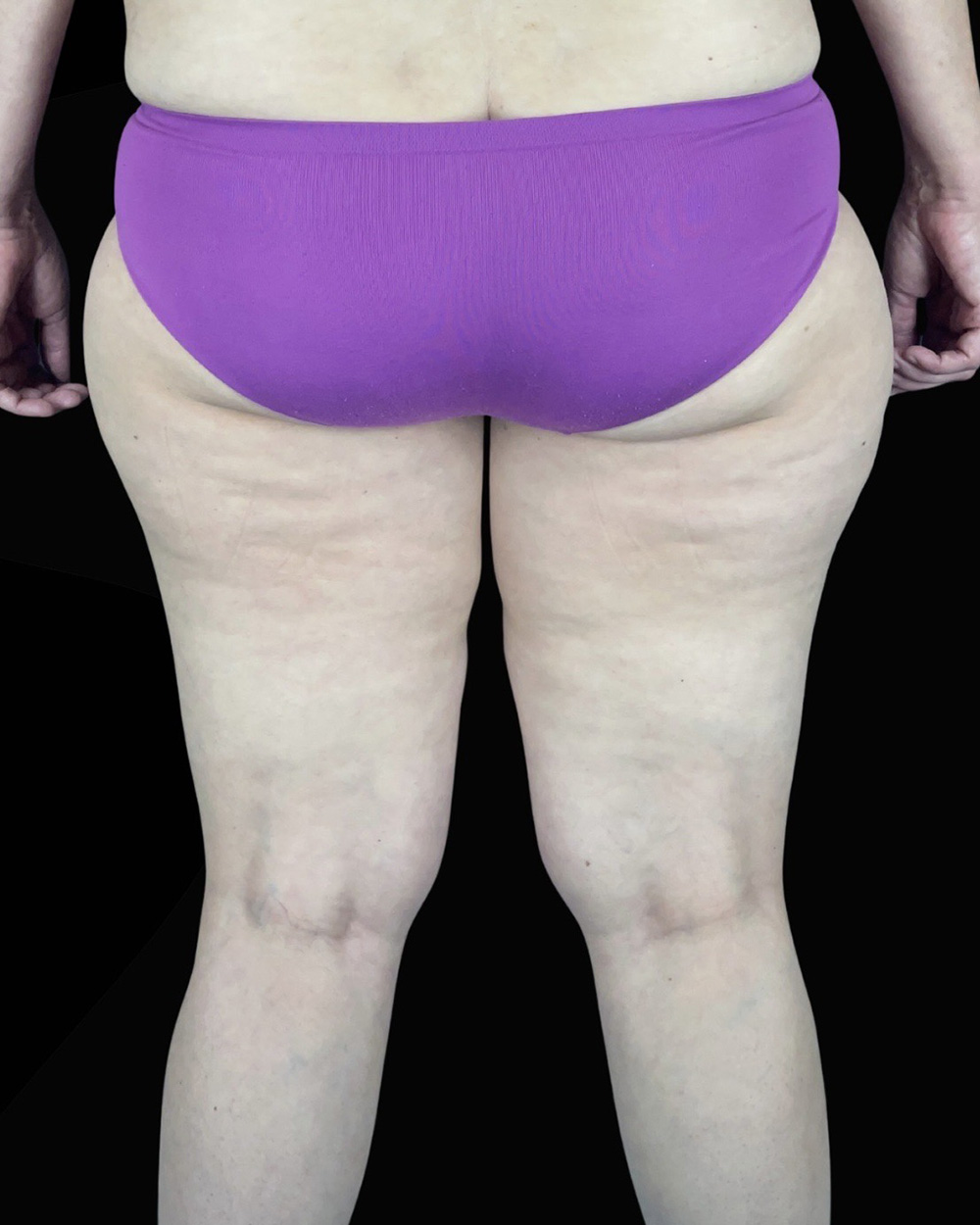 Case--1961 | Before Liposuction 4