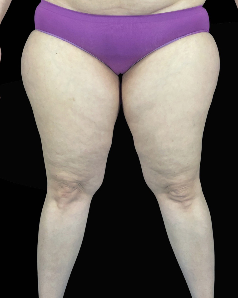 Case--1961 | Before Liposuction 3