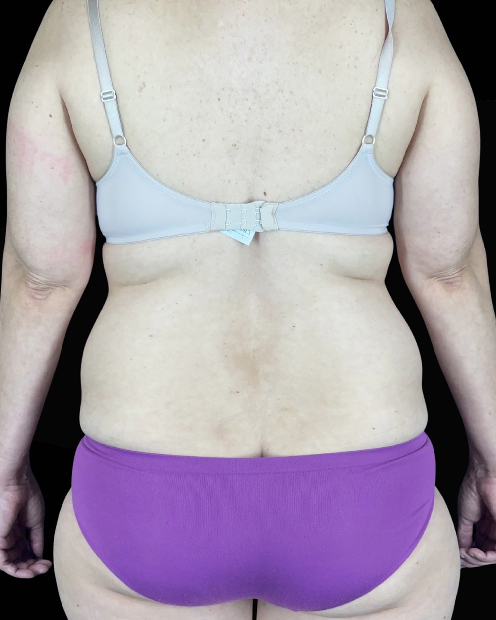 Case--1961 | Before Liposuction 2