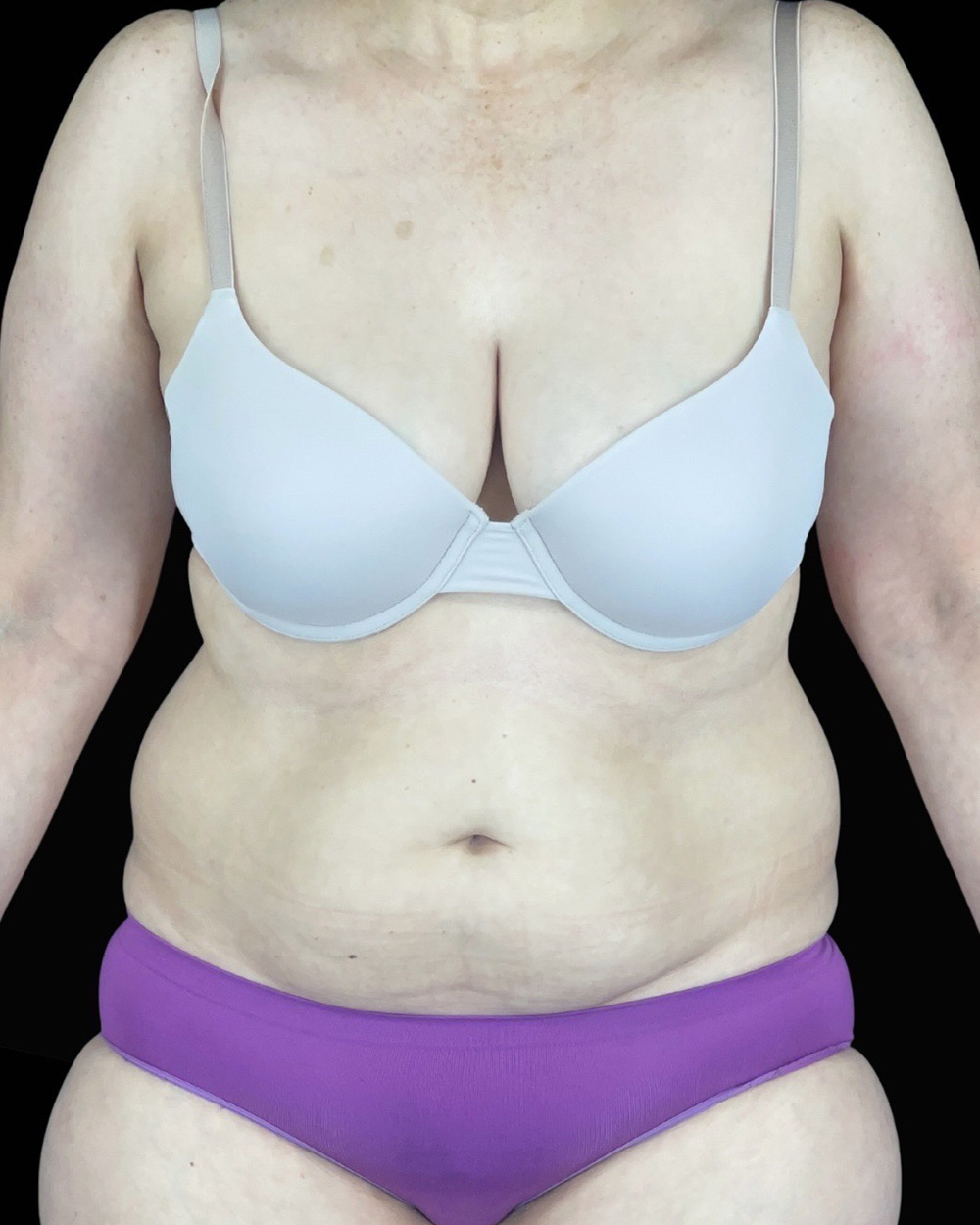 Case--1961 | Before Liposuction