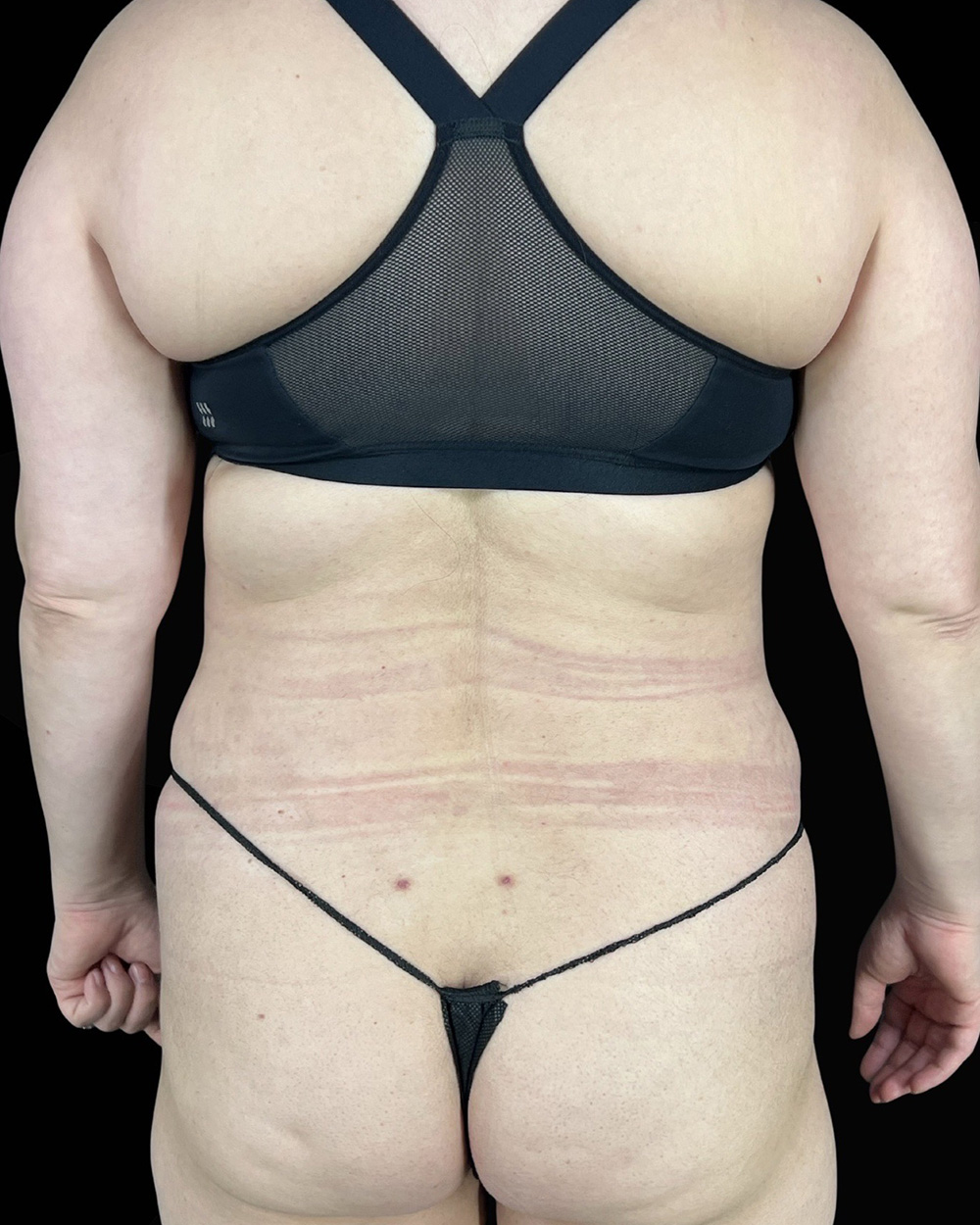 Case--3652 | After Liposuction