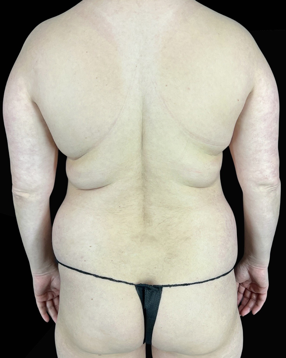 Case--3652 | Before Liposuction