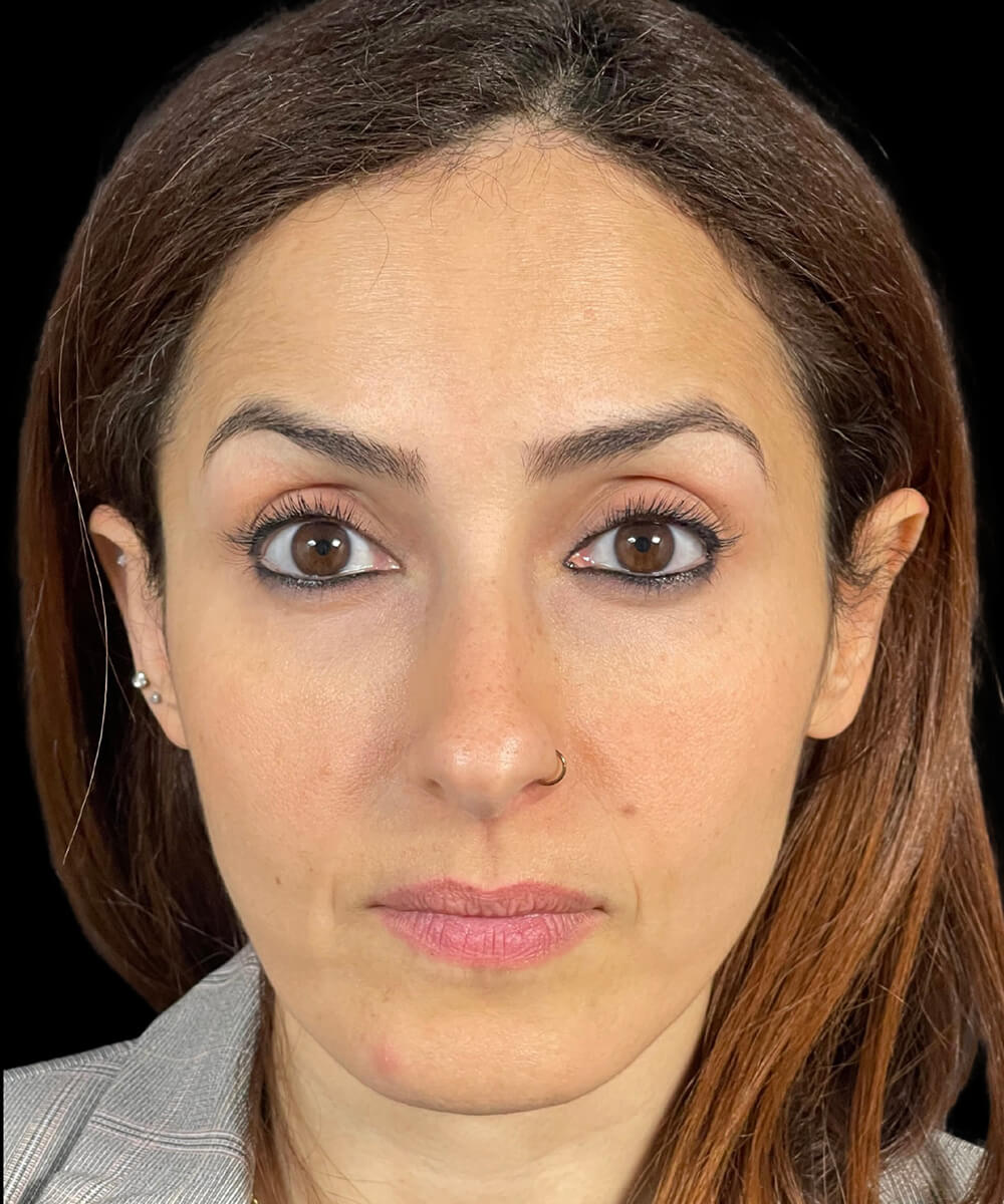 Case--4565 | After BOTOX® Cosmetic/Dysport®