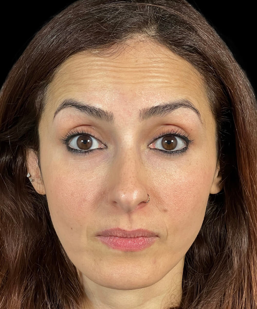 Case--4565 | Before BOTOX® Cosmetic/Dysport®