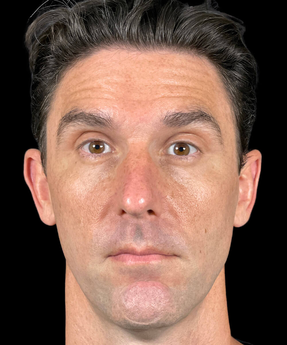 Case--6263 | Before BOTOX® Cosmetic/Dysport®