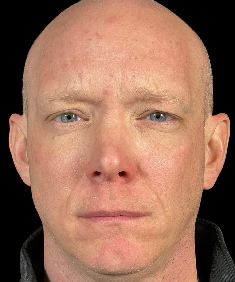 Case--3828 | After BOTOX® Cosmetic/Dysport®