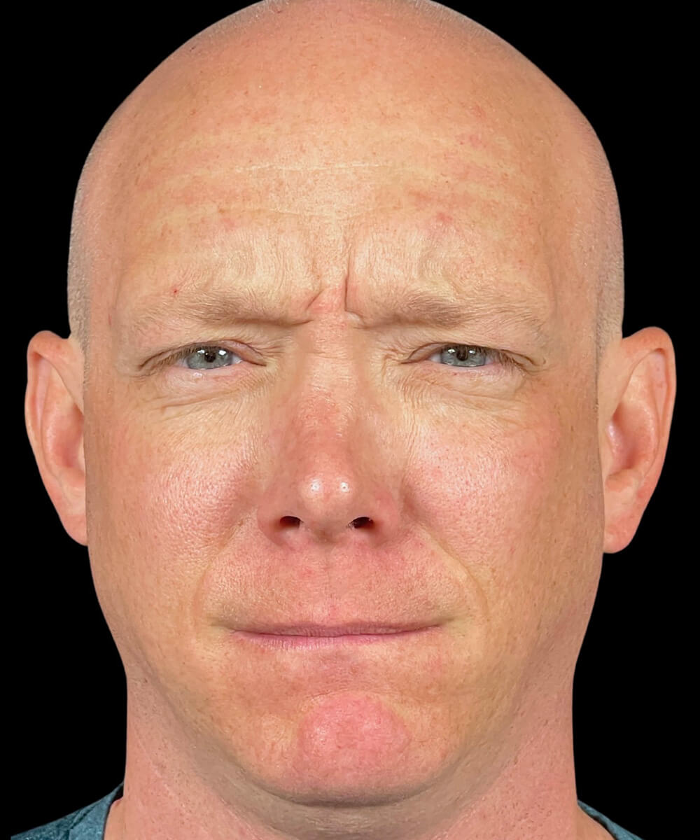 Case--3828 | Before BOTOX® Cosmetic/Dysport®