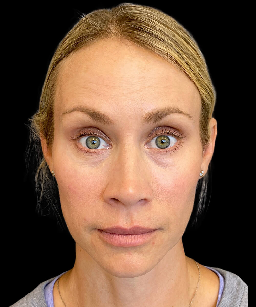 Case--9145 | After BOTOX® Cosmetic/Dysport®