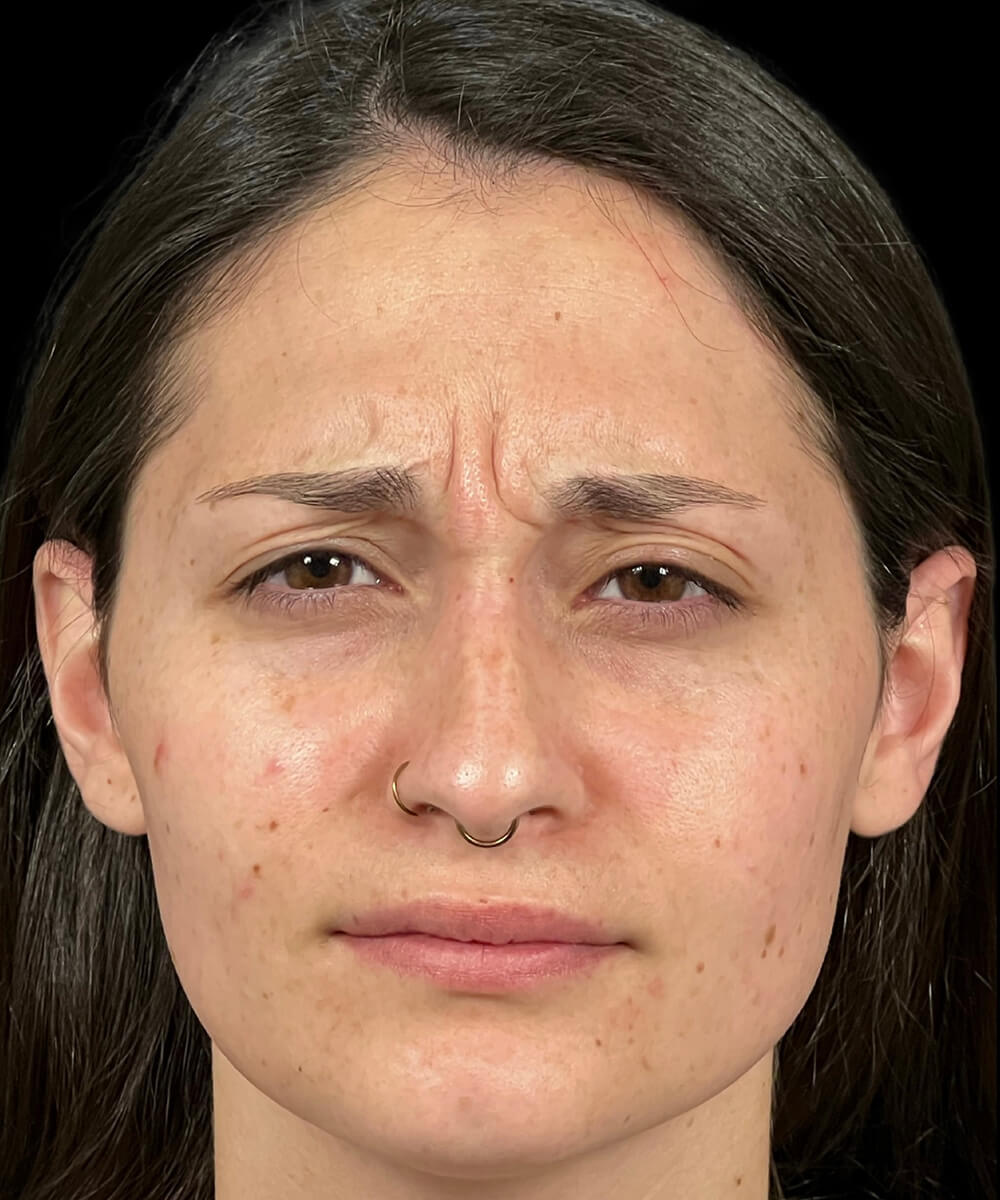 Case--2879 | Before BOTOX® Cosmetic/Dysport®