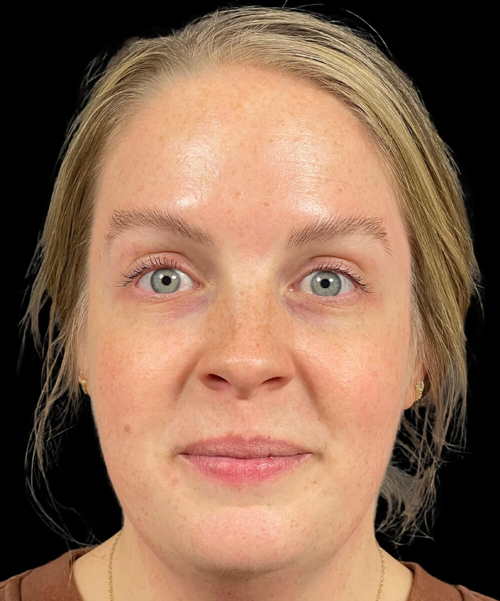 Case--6683 | After BOTOX® Cosmetic/Dysport® 2