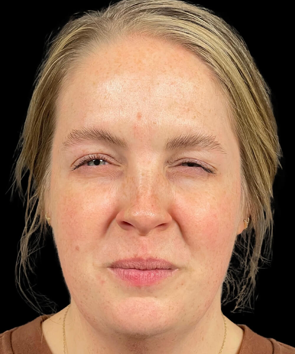 Case--6683 | After BOTOX® Cosmetic/Dysport®