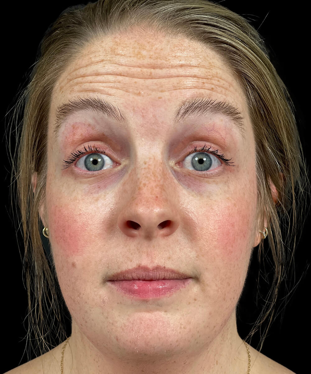 Case--6683 | Before BOTOX® Cosmetic/Dysport® 2