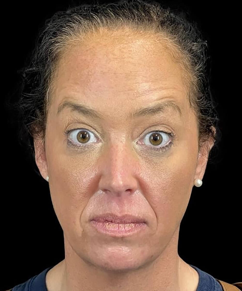 Case--5386 | After BOTOX® Cosmetic/Dysport®