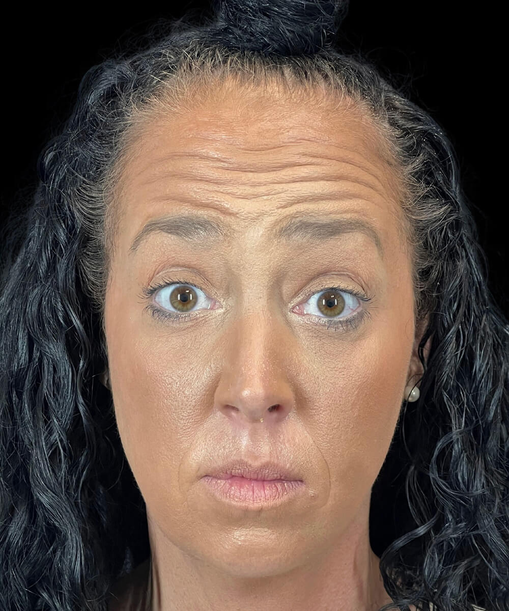 Case--5386 | Before BOTOX® Cosmetic/Dysport®