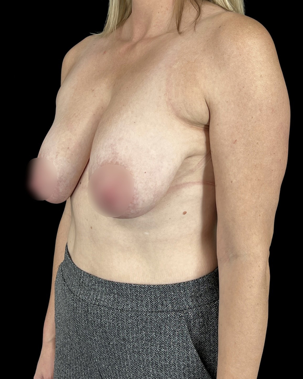 Case--8006 | Before Breast Reduction/Lift 2