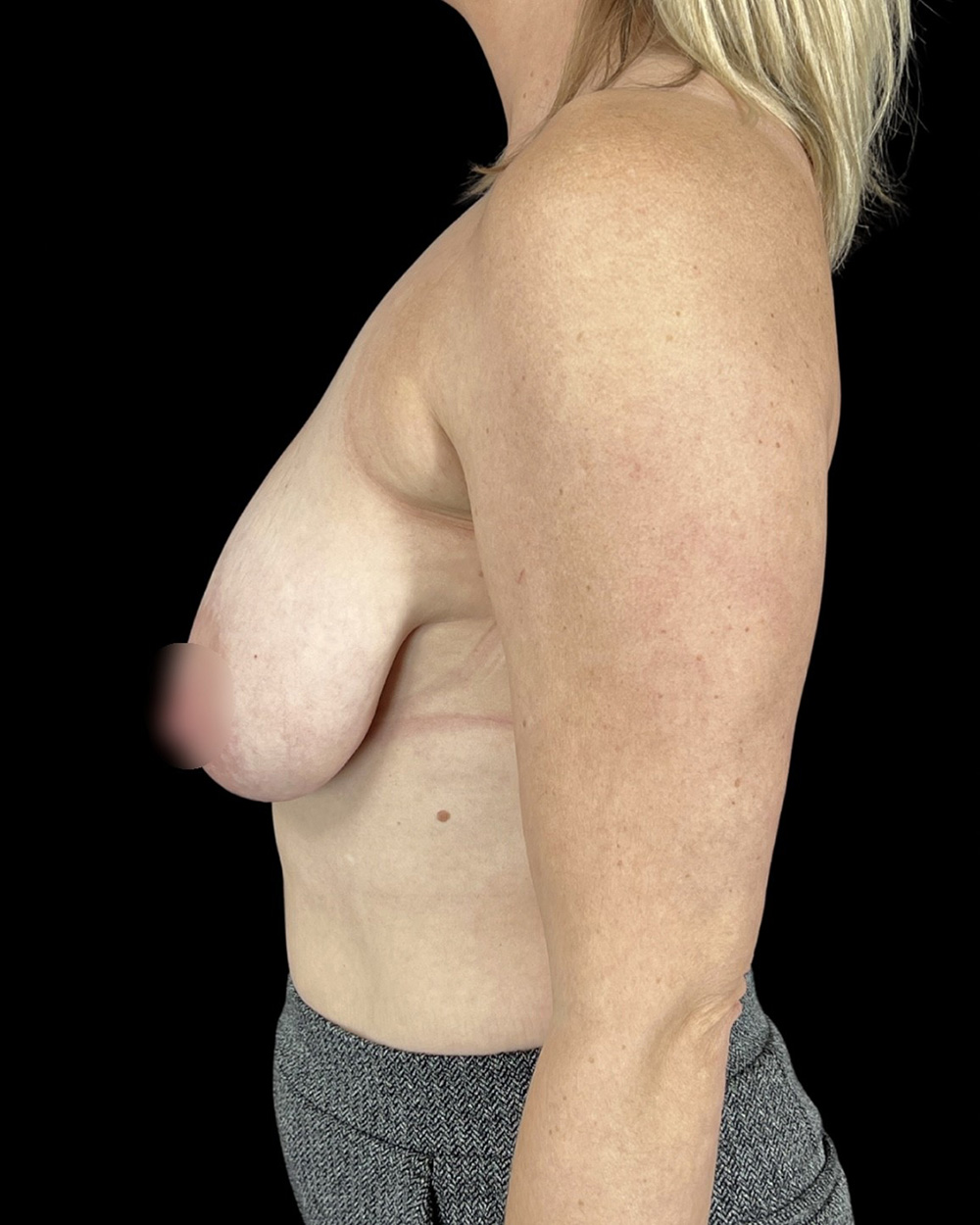 Case--8006 | Before Breast Reduction/Lift 3