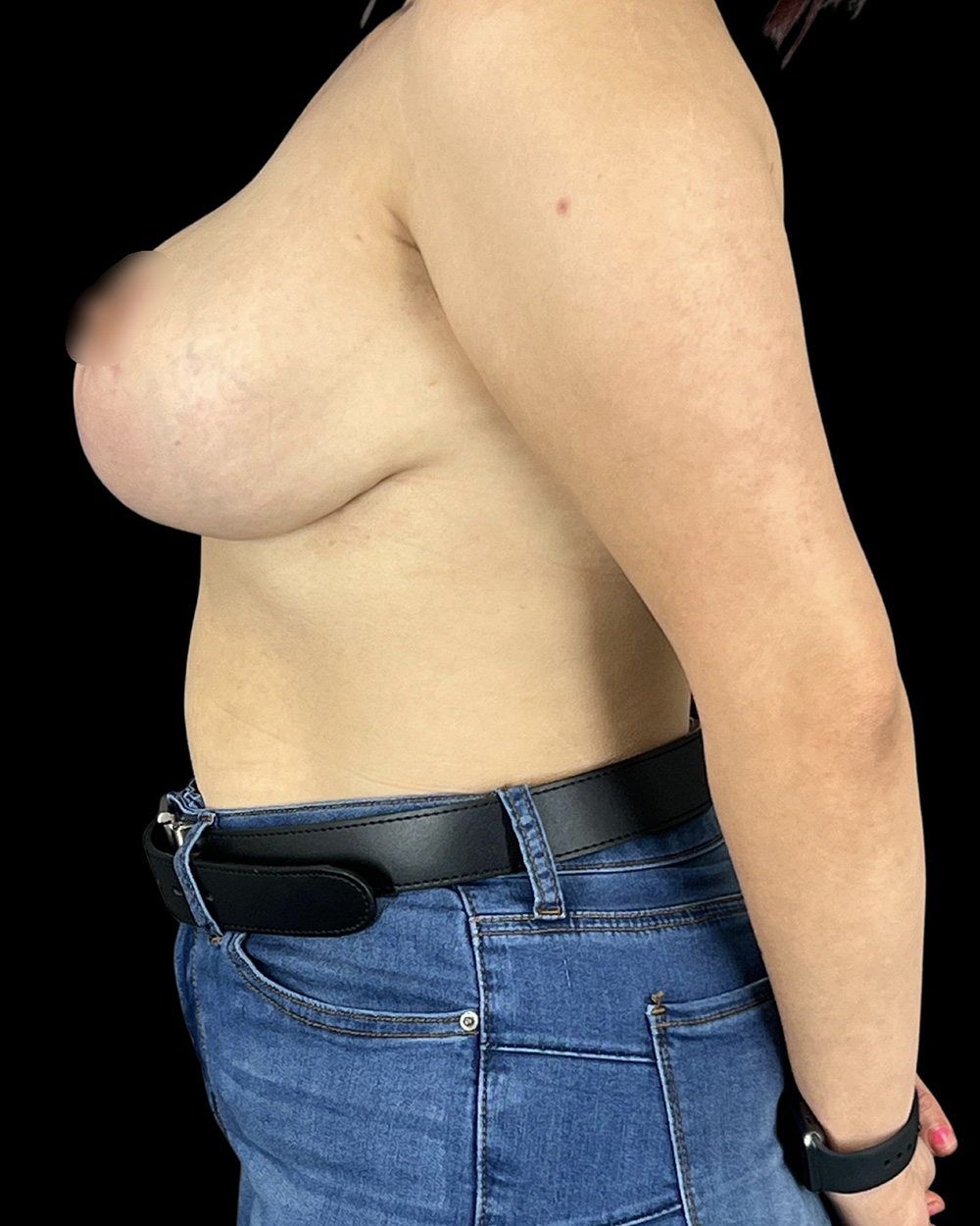 Case--6734 | After Breast Reduction/Lift 2