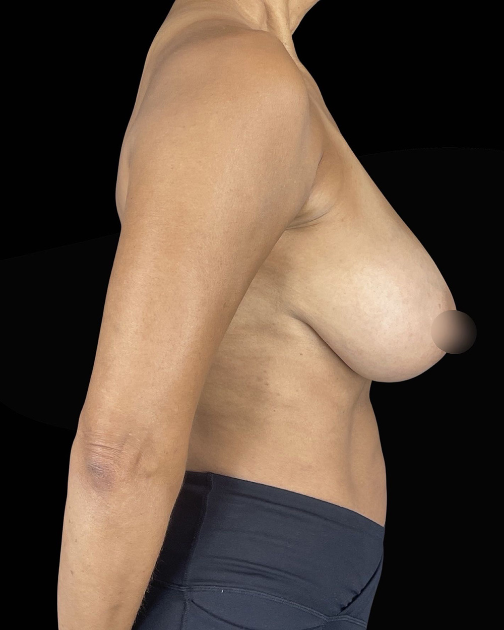 Case--2477 | Before Breast Reduction/Lift 3