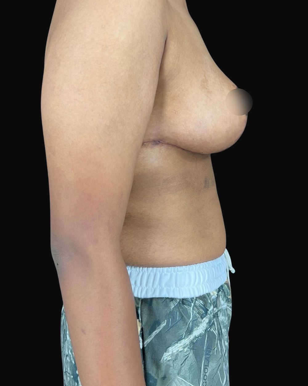 Case--7667 | After Breast Reduction/Lift 3