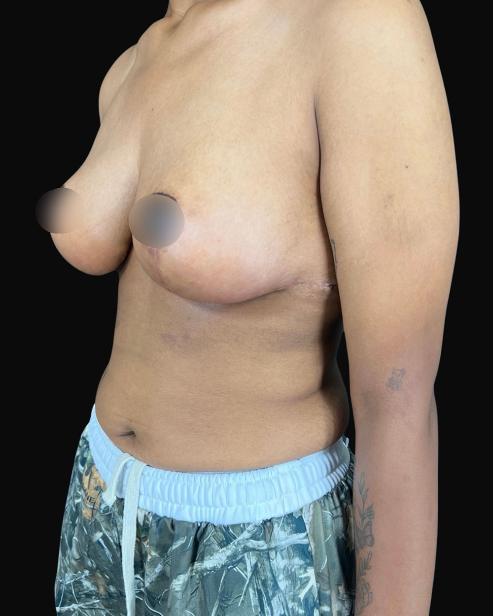 Case--7667 | After Breast Reduction/Lift 2