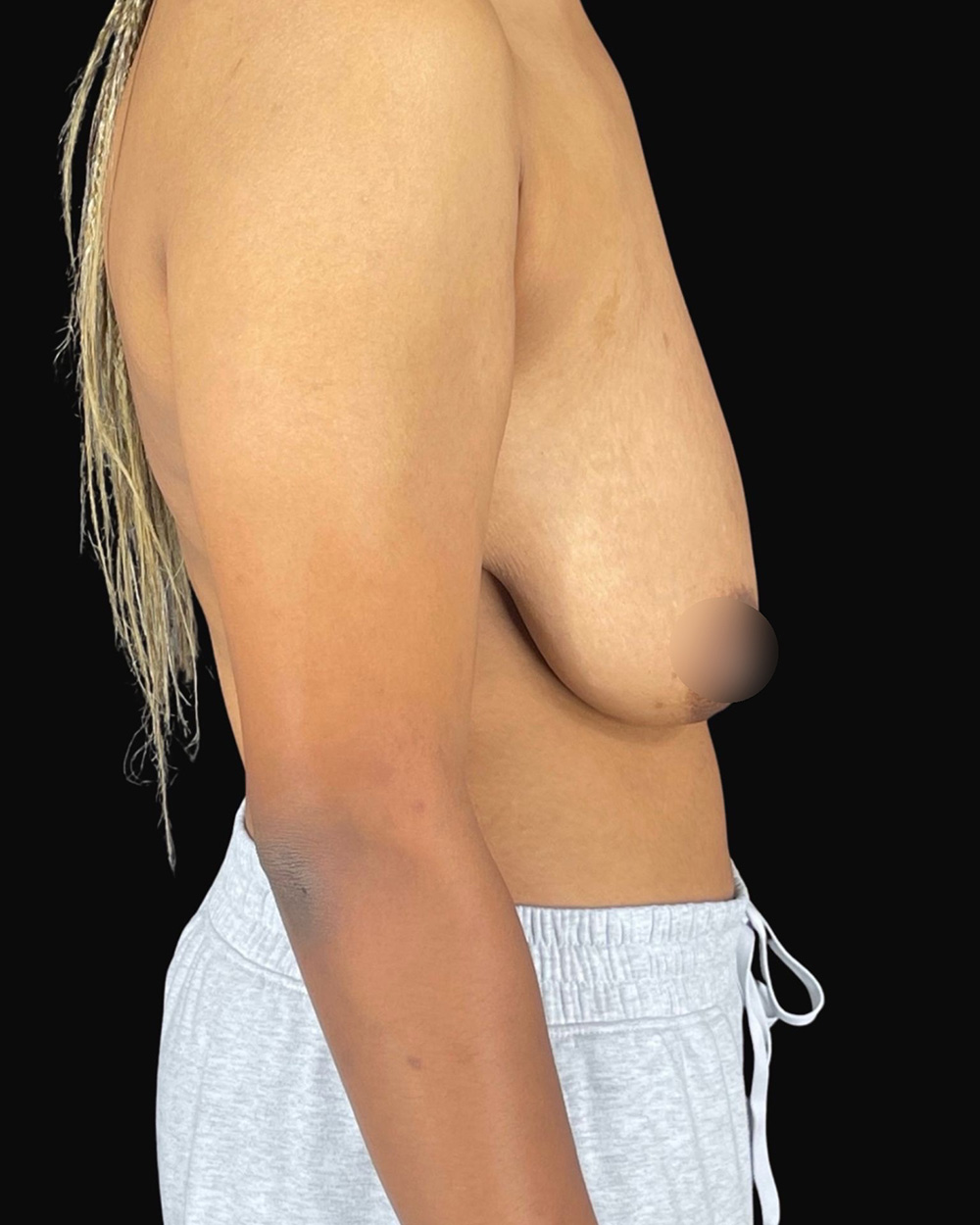 Case--7667 | Before Breast Reduction/Lift 3