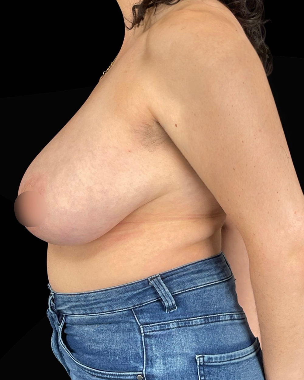 Case--7705 | Before Breast Reduction/Lift 2