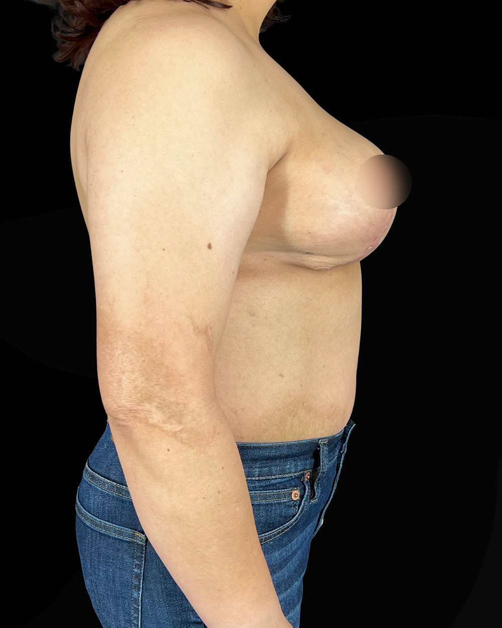 Case--3580 | After Breast Reduction/Lift 3