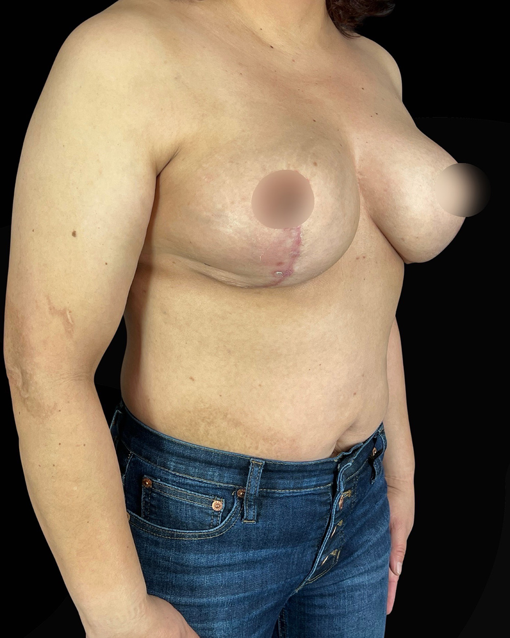 Case--3580 | After Breast Reduction/Lift 2