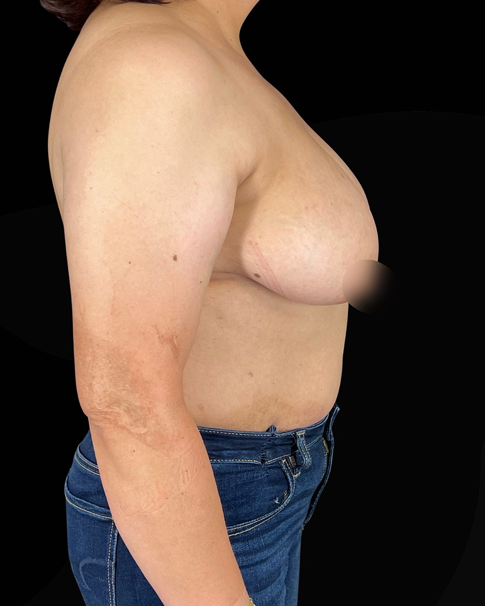 Case--3580 | Before Breast Reduction/Lift 3